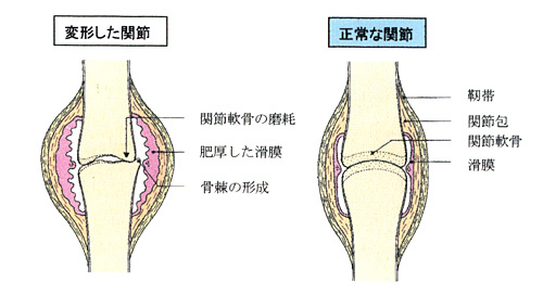 膝痛