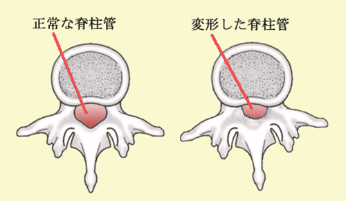 狭窄